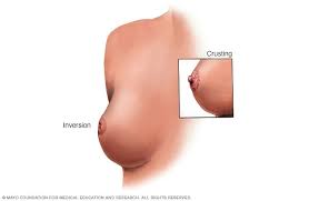 What is normal for you may not be normal for another woman. Breast Cancer Symptoms And Causes Mayo Clinic