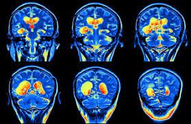 Ask for a brain scan if you have symptoms of tumors, strokes, or aneurysms. Brain Scans Mri Scan Ct Scan Bhf
