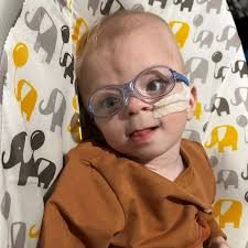 Miracle baby born without part of his brain survives to celebrate his first  birthday