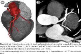 There are multiple smaller coronary arteries that branch off from the left and right coronary artery and even the circumflex artery. Left Circumflex Coronary Artery Originating From Left Anterior Descending Artery And First Diagonal Branch Computed Tomography Angiography Findings Of Extremely Rare Two Cases Abstract Europe Pmc