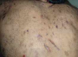 Image result for Neurotic Excoriation