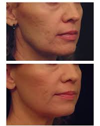 Laser Skin Tightening Of The Face Performed At Michael Law Md Aesthetic Plastic Surgery Blue Water Spa Htt Laser Skin Tightening Laser Skin Plastic Surgery