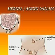 Hernia atau dikenali sebagai angin pasang, uluran dan medu angin adalah penyakit yang kebiasaannya dialami oleh kaum lelaki tidak kira samada lelaki dewasa atau. Bio Ever Cream Ajaib Apa Dia Hernia Angin Pasang Bayi Atau Kanak Kanak Lelaki Lebih Cenderung Menghidap Penyakit Angin Pasang Berbanding Bayi Dan Kanak Kanak Perempuan Dalam Kalangan Bayi Baru Lahir
