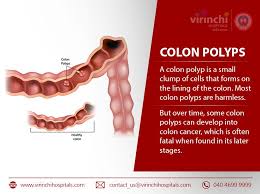 Colon Polyps Polyps Colon Polyp Healthy Colon