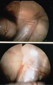 Cryptorchidism is often the cause of the disruption of the hormonal and reproductive function of. The Undescended Testicle Diagnosis And Management American Family Physician