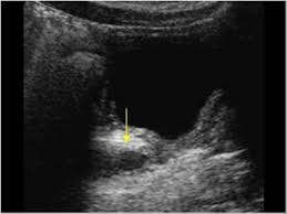 Pediatrics 9 2 Pediatric Urinary Tract Case 9 2 8 Miscellaneous Urinary Tract Ultrasound Cases