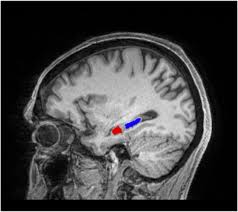 Image result for Temporal Lobe