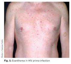 Image result for skin rash acute hiv infection