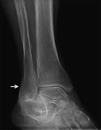 Image result for periostitis