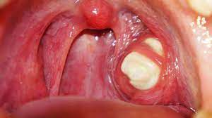 The symptoms of yeast is allows bacteria and post nasal drip. Understanding The Tonsil Stones Abbotsford Dental