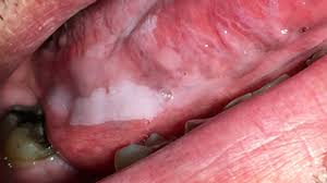The early symptoms of throat cancer may be similar to a cold in the early stages (e.g., a persistent sore throat). Self Oral Cancer Screening Socs Education Program School Of Dentistry Lsu Health New Orleans
