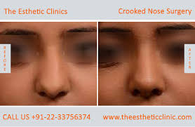 The average cost of rhinoplasty is $5,409, according to 2019 statistics from the american society of plastic surgeons. Rhinoplasty Surgery Mumbai Best Nose Job Surgeons Cost India The Esthetic Clinics