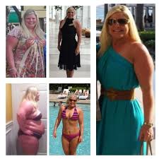 Sleeve Gastrectomy Before And After Gastric Sleeve Before And After Gastric Sleeve Forum Ammcnutt Gastric Sleeve Sleeve Surgery Sleeve Gastrectomy