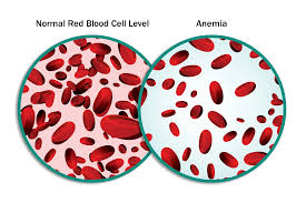 Image result for Anemia angolensis