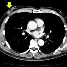Each has its own strengths. Mammogram Showing A Round High Density Mass In The Right Breast A Download Scientific Diagram