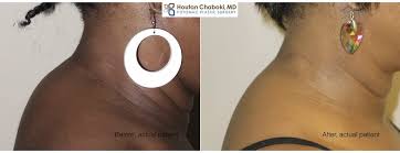We did not find results for: How To Get Rid Of A Buffalo Hump Excess Fat Behind The Neck