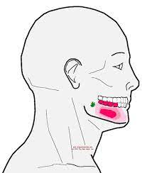 Pin On Tmj Trigger Point Pain