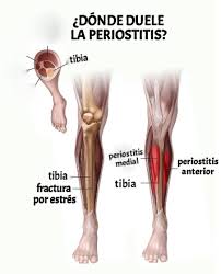 Image result for periostitis