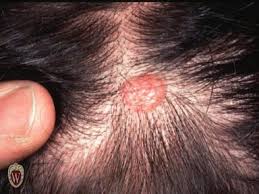 Then i noticed a spot that seemed different from the others. Pin On Skin Cancer 2