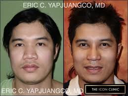 Asian Rhinoplasty