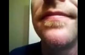 A post shared by pimple popping videos (@pimplepoppervids). Pimples 8 Most Disgusting Zip Popping Videos Oddee