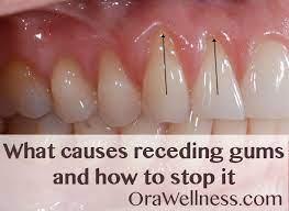 What Causes Receding Gums And How To Stop It Orawellness Gum Disease Treatment Receding Gums Teeth Health