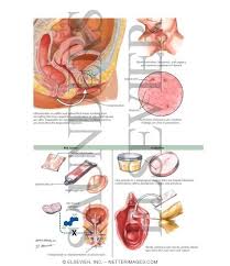 Image result for Dysuria