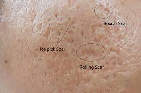How to get rid of ice pick scars. Acne Scar Treatment Acne Scar Removal Read More