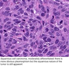 It is commonly abbreviated scc. Pathology Outlines Squamous Cell Carcinoma