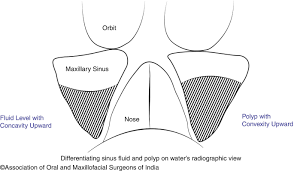 Image result for Maxillary Sinus