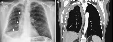 Pleural effusion is classically divided into transudate and exudate based on the light criteria. Diseases Of The Chest Wall Pleura And Diaphragm Springerlink