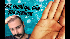 Sac Ekimi 44 Gun Sok Dokulme Video 4 Youtube