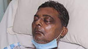 May 12, 2021 · in the most severe cases, the infection can result in the growth of black patches around the eyes, nose. Black Fungus New Scare In India As Second Covid Wave Ebbs Coronavirus Pandemic News Al Jazeera