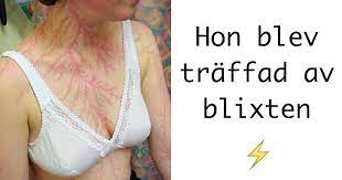 Men om träden är vissna och förtorkade utan blad, omkullvälta, förkolnade av brand eller splittrade av ett blixtnedslag, väntar vrede, rädsla, missnöje och sorg. Lichtenberg Monster Det Hander Med Huden Nar Du Traffas Av Blixten