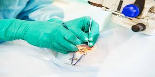 Das hagelkorn (chalazion) entsteht durch eine verlegung einer art von drüsen am augenlid. Operation Bei Einem Hagelkorn