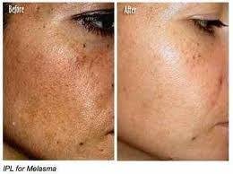 Before And After Black And White Bleaching Cream Reviews Pin On Skin Brightener