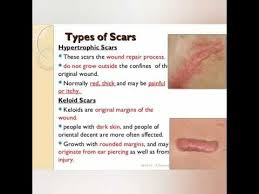 I have seen these in real life. Keloid Hypertrophic Scar University Exams Youtube