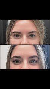 🖊️Advanced Scar Revision Therapy ☑️Done with precision, intention, &  expertise. ✈️ Traveling in? Ask us about concierge scheduling & hotel recs!  ✨This is true skin healing, from the inside out. At COMPLEXIONS