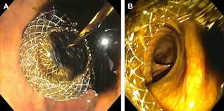 Axios™ stent and electrocautery enhanced delivery system animation. Specially Designed Stents For Translumenal Drainage Sciencedirect