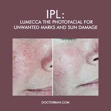 13 most affordable first time underarm ipl packages in singapore from $38 for 6 sessions. Ipl Lumecca The Photofacial For Unwanted Marks And Sun Damage At Dr Rahi S Integrative Aesthetics Specialist