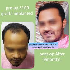 Indian Hair Transplant