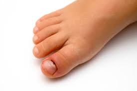 Image result for Akutní zánět nehtového lůžka