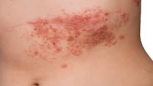 The rash of erythema multiforme appears as symmetrical plaques on hands, forearms, feet and lower legs. Is It Shingles Virus Or Something Else Everyday Health