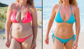 The lap sites from all the incisions are still pretty noticeable, but they are a pretty pink color. Stomach Sleeve Surgery In Mexico Gastric Sleeve Mexico