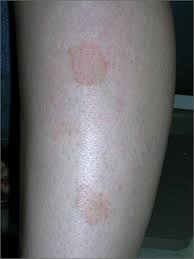 It grows outward and spreads across the skin, normally starting at the trunk, or central, part of the body. Marks On Lower Leg Mdedge Family Medicine