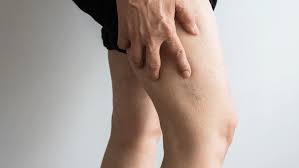 Thrombose Bei Ausdauersportlern Runner S World