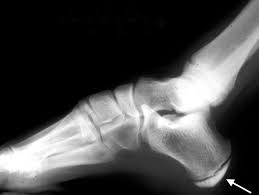 Image result for Calcaneal Apophysitis