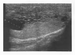 Tubular ectasia of the rete testis is a recently recognized entity whose sonographic appearance has been described principally in the radiological literature. Tubular Ectasia Of The Rete Testis Associated With Azoospermia A Case Report Semantic Scholar
