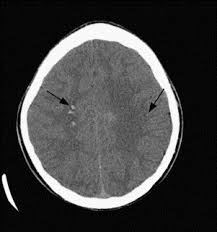 Image result for Diffuse Axonal Injury