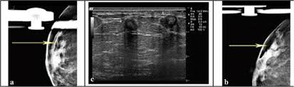 Did not respond to antibiotic and was referred for biopsy. Fat Necrosis In The Breast A Systematic Review Of Clinical Lipids In Health And Disease Full Text